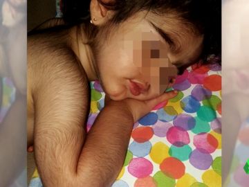 Niña con hipertricosis por omeprazol contaminado Niña con hipertricosis por omeprazol contaminado