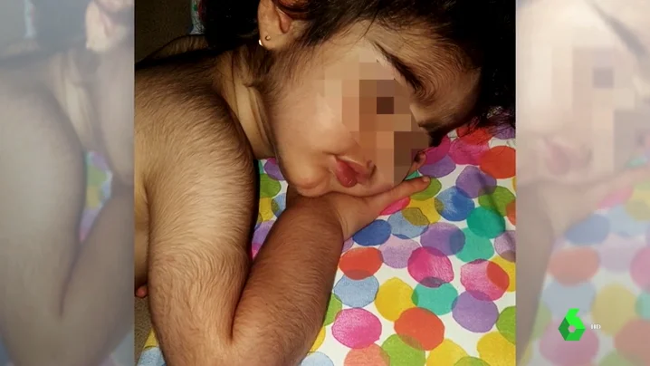 Niña con hipertricosis por omeprazol contaminado