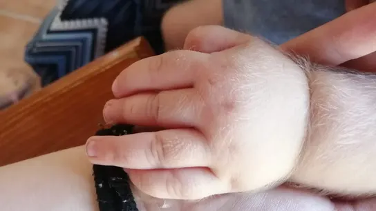 Bebé afectado por hipetricosis o 'síndrome del hombre lobo' Bebé afectado por hipetricosis o 'síndrome del hombre lobo'