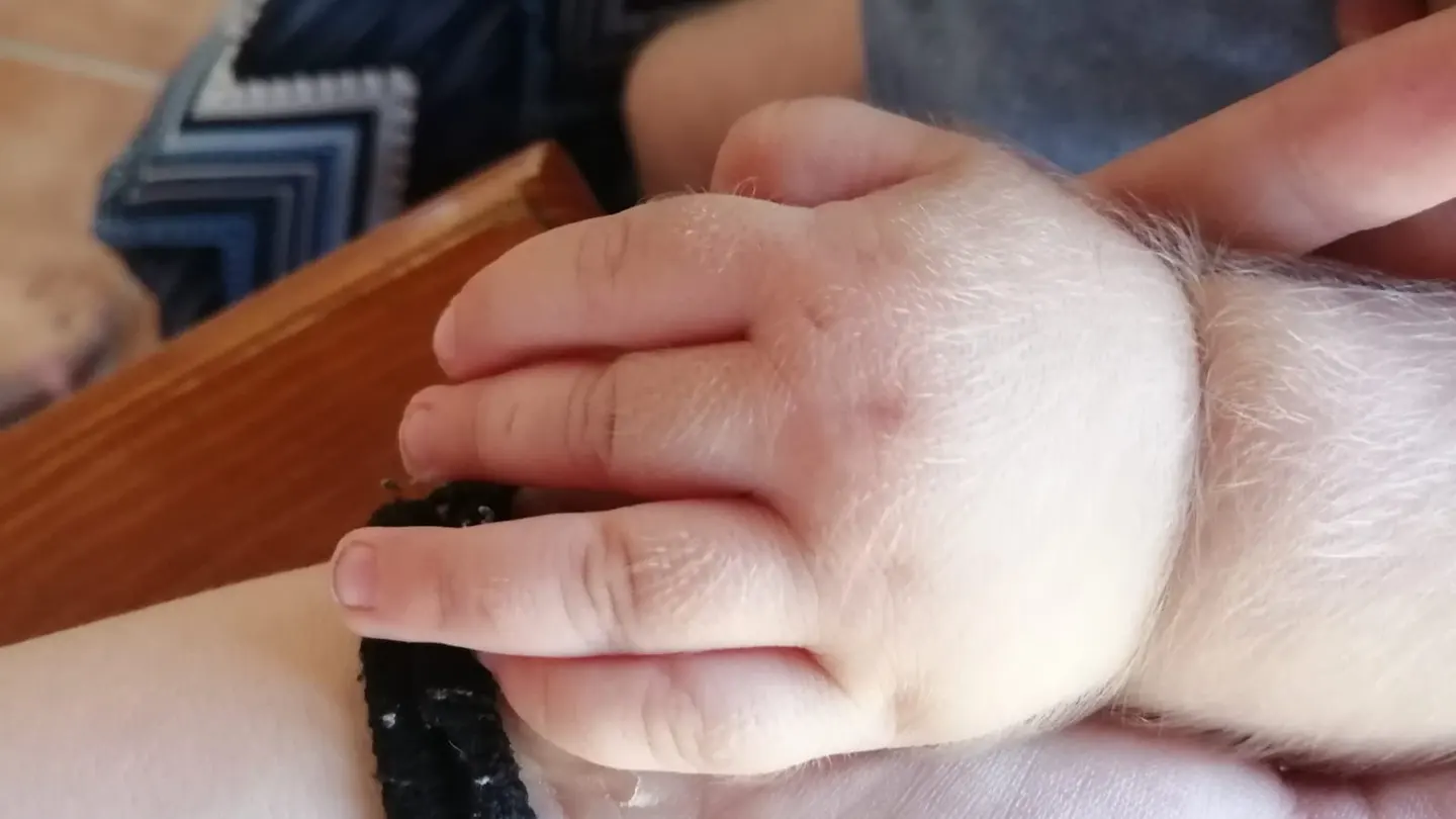 Bebé afectado por hipetricosis o 'síndrome del hombre lobo' Bebé afectado por hipetricosis o 'síndrome del hombre lobo'