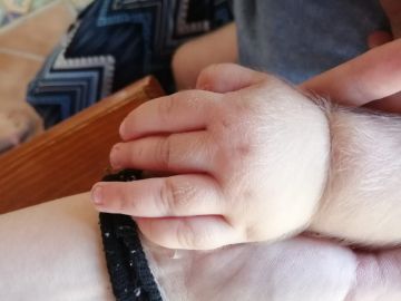 Bebé afectado por hipetricosis o 'síndrome del hombre lobo' Bebé afectado por hipetricosis o 'síndrome del hombre lobo'