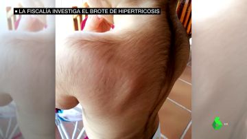 Niño con hipetricosis por omeprazol contaminado