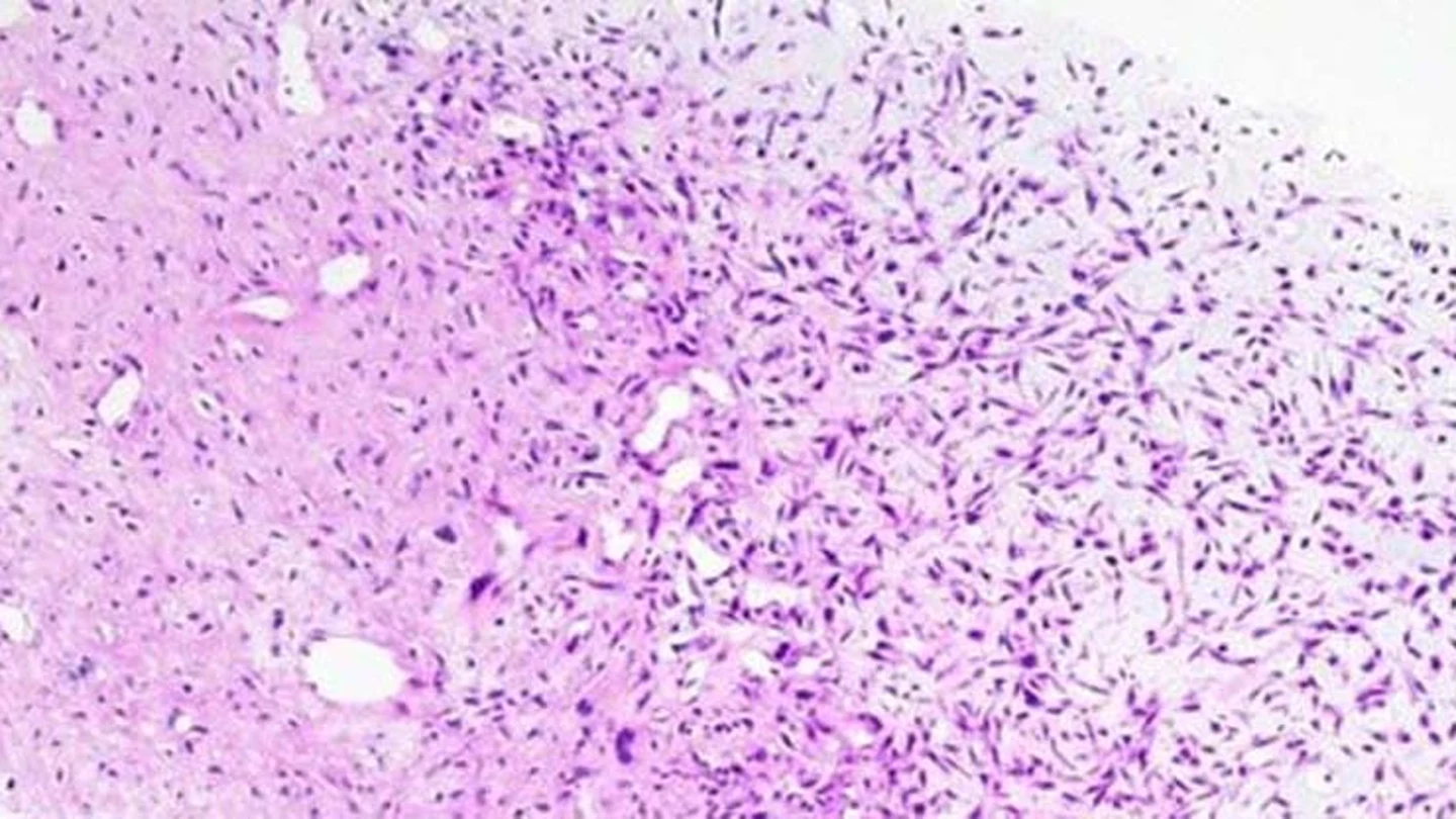 Osteosarcoma Osteosarcoma