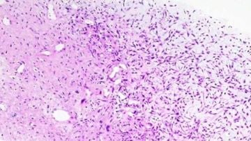 Osteosarcoma