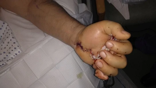 Mano del hombre después de la cirugía Mano del hombre después de la cirugía.