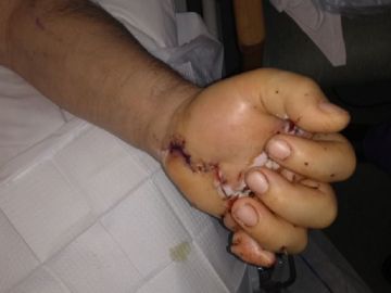 Mano del hombre después de la cirugía