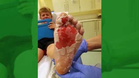 Un niño pisa unas brasas enterradas bajo la arena de la playa Un niño pisa unas brasas enterradas bajo la arena de la playa.