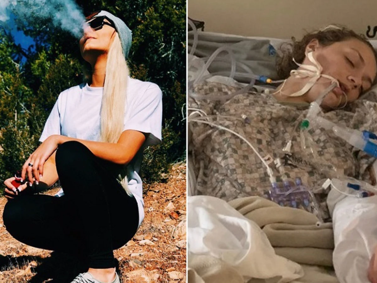 Vapeo: una joven acaba en coma inducido por una neumona causada por consumir un cigarrillo electrnico Vapeo: una joven acaba en coma inducido por una neumona causada por consumir un cigarrillo electrnico