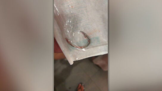 Imagen que prueba el gran tamaño del anzuelo que Juan tenía clavado en el cuello.