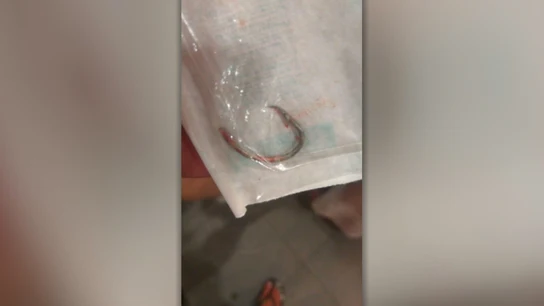 Imagen que prueba el gran tamaño del anzuelo que Juan tenía clavado en el cuello. Imagen que prueba el gran tamaño del anzuelo que Juan tenía clavado en el cuello.