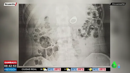 Una mujer sueña que se ha tragado su anillo de compromiso y se despierta con la joya en el estómago Una mujer sueña que se ha tragado su anillo de compromiso y se despierta con la joya en el estómago