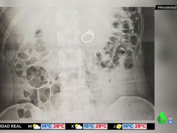 Una mujer sueña que se ha tragado su anillo de compromiso y se despierta con la joya en el estómago Una mujer sueña que se ha tragado su anillo de compromiso y se despierta con la joya en el estómago