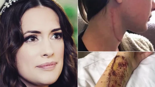 Reconstruyen la lengua a una joven con cáncer con injertos del músculo de su brazo Reconstruyen la lengua a una joven con cáncer con injertos del músculo de su brazo