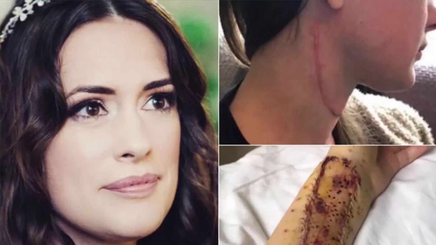 Reconstruyen la lengua a una joven con cáncer con injertos del músculo de su brazo Reconstruyen la lengua a una joven con cáncer con injertos del músculo de su brazo