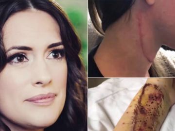 Reconstruyen la lengua a una joven con cáncer con injertos del músculo de su brazo Reconstruyen la lengua a una joven con cáncer con injertos del músculo de su brazo