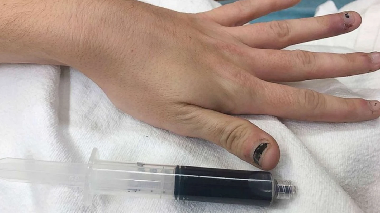 Imagen de la joven cuya sangre se volvió azul por automedicarse para un dolor de muelas Imagen de la joven cuya sangre se volvió azul por automedicarse para un dolor de muelas