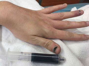 Imagen de la joven cuya sangre se volvió azul por automedicarse para un dolor de muelas Imagen de la joven cuya sangre se volvió azul por automedicarse para un dolor de muelas
