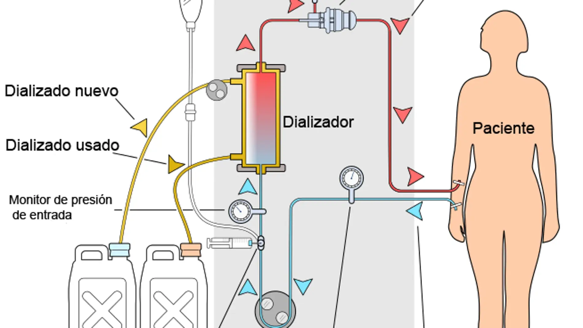 Diagrama esquemático de un circuito de hemodiálisis