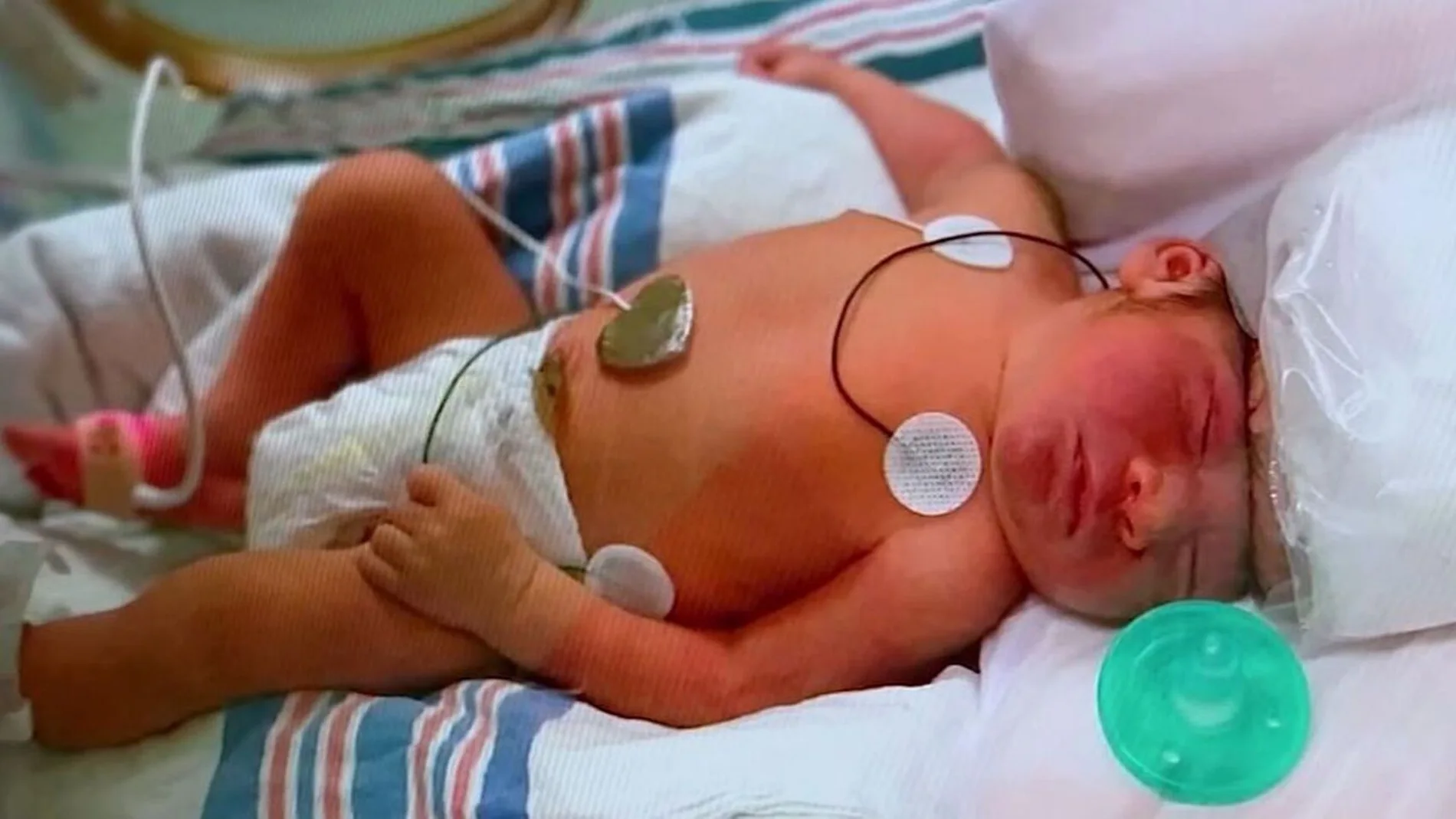 Lucas, el primer bebé que nace con medio cerebro fuera del cráneo y logra sobrevivir