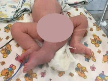 Imagen del bebé que nació con tres piernas en Rusia Imagen del bebé que nació con tres piernas en Rusia