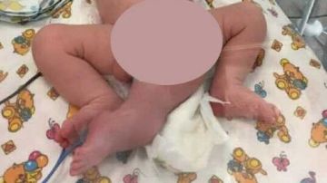 Imagen del bebé que nació con tres piernas en Rusia