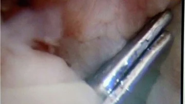 Los médicos tuvieron que presionar las pinzas desde el exterior del pene para poder sacarlas.