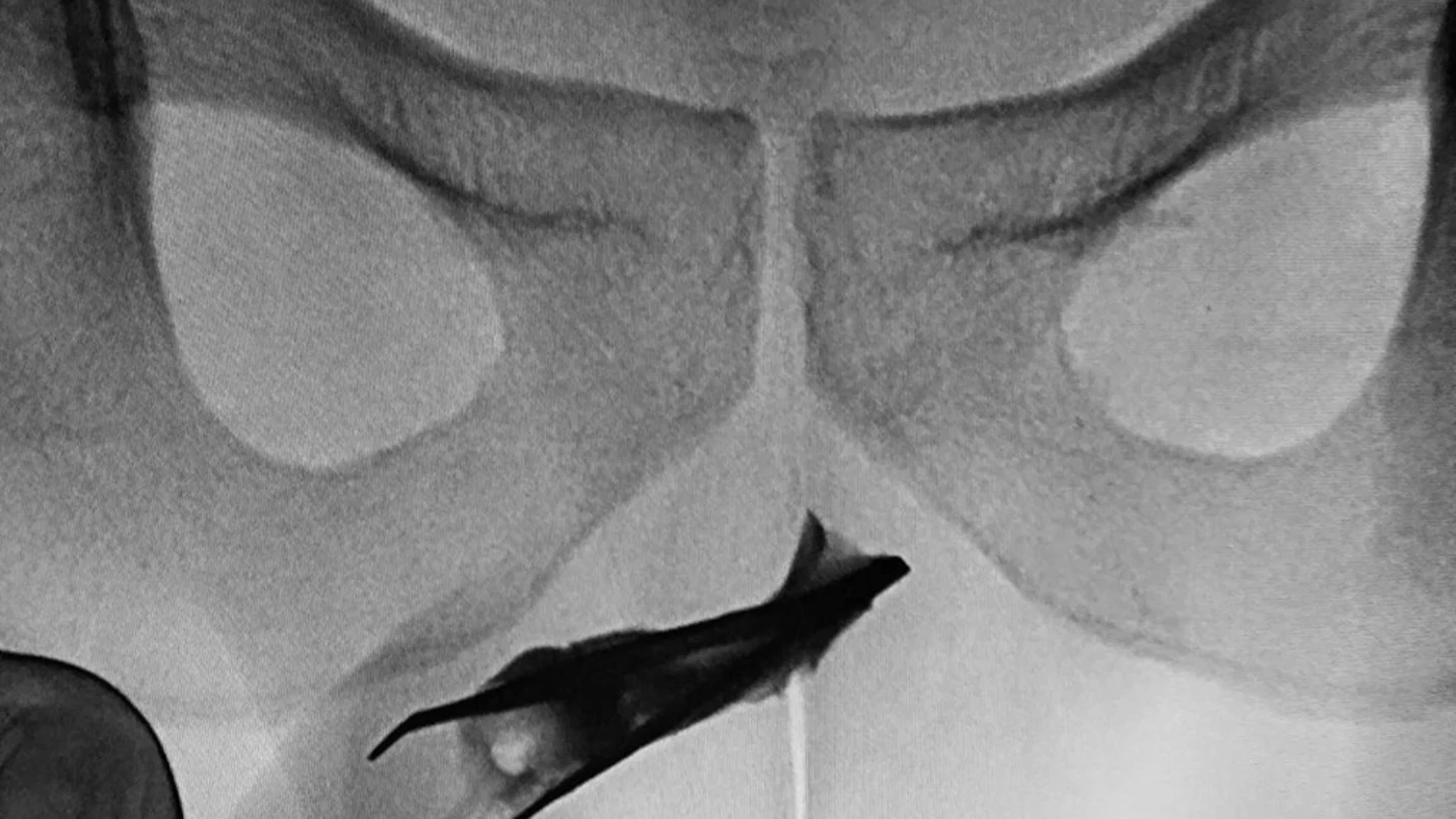 Los médicos descubrieron mediante una radiografía que el joven tenía unas pinzas de depilar en su interior. Los médicos descubrieron mediante una radiografía que el joven tenía unas pinzas de depilar en su interior.