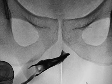 Los médicos descubrieron mediante una radiografía que el joven tenía unas pinzas de depilar en su interior. Los médicos descubrieron mediante una radiografía que el joven tenía unas pinzas de depilar en su interior.