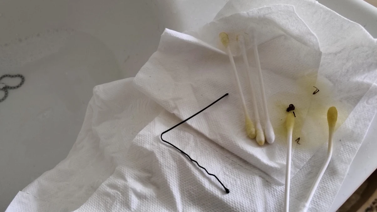 Bastoncillos con los que Liam Gómez sacó una araña de su oído Bastoncillos con los que Liam Gómez sacó una araña de su oído