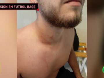 Un padre agrede brutalmente a un árbitro en un partido de alevines Un padre agrede brutalmente a un árbitro en un partido de alevines