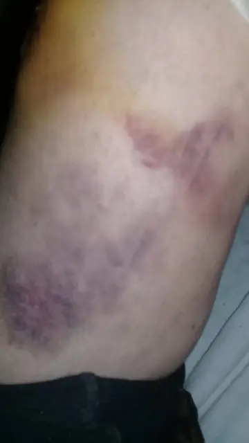 Imagen de las heridas y contusiones que habría sufrido Gisela Knorr por la paliza Imagen de las heridas y contusiones que habría sufrido Gisela Knorr por la paliza