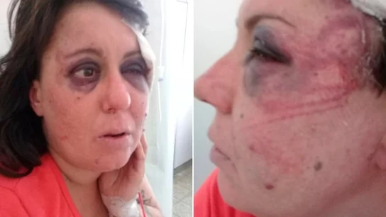 Fotos de las heridas y contusiones de Gisela Knorr difundidas por la familia Fotos de las heridas y contusiones de Gisela Knorr difundidas por la familia