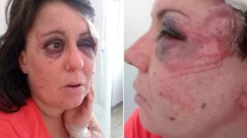 Fotos de las heridas y contusiones de Gisela Knorr difundidas por la familia