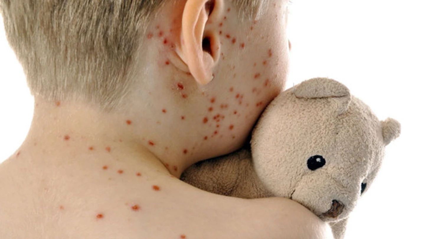 Niño infectado con sarampión Niño infectado con sarampión
