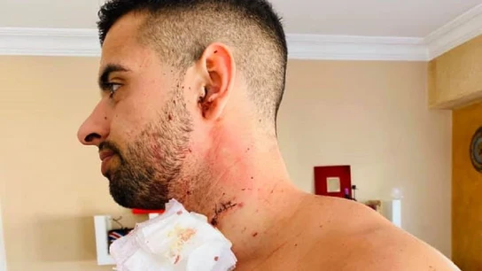 Juan Antonio Verdera ha recibido 17 puntos de sutura Juan Antonio Verdera ha recibido 17 puntos de sutura