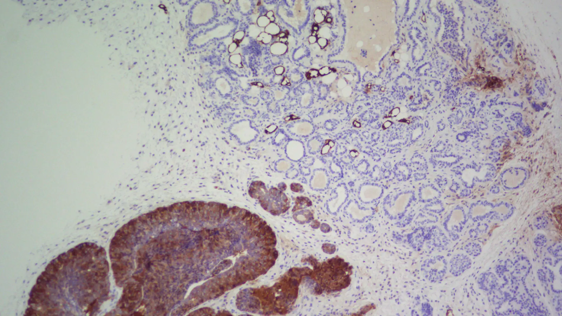 Imagen de inmunohistoquímica de FASN. / CNIO