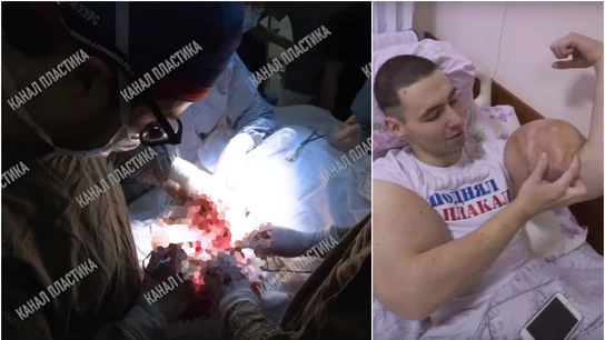 Momento de la operación del Popeye ruso Momento de la operación del Popeye ruso