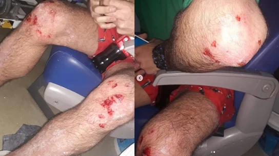 Imagen de las heridas tras el ataque homófobo Imagen de las heridas tras el ataque homófobo
