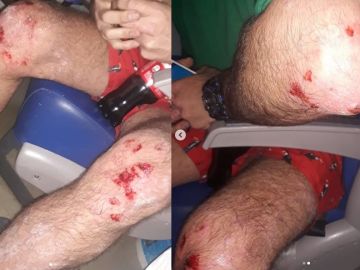 Imagen de las heridas tras el ataque homófobo Imagen de las heridas tras el ataque homófobo