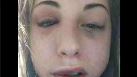 Imagen compartida por Caterina DegliEsposti en sus redes sociales tras la agresión. Imagen compartida por Caterina DegliEsposti en sus redes sociales tras la agresión.