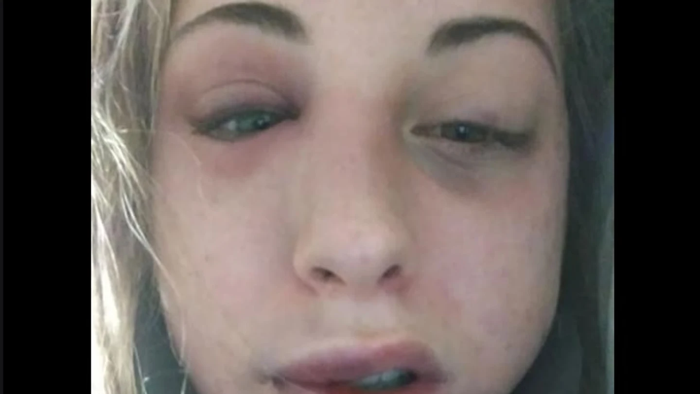 Imagen compartida por Caterina DegliEsposti en sus redes sociales tras la agresión. Imagen compartida por Caterina DegliEsposti en sus redes sociales tras la agresión.