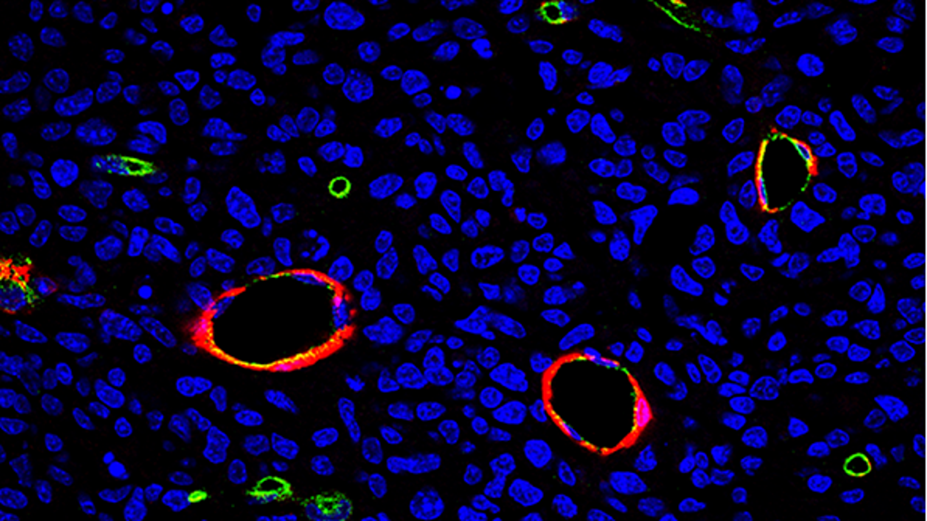 células tumorales (en azul) creciendo alrededor de vasos sanguíneos (en verde)