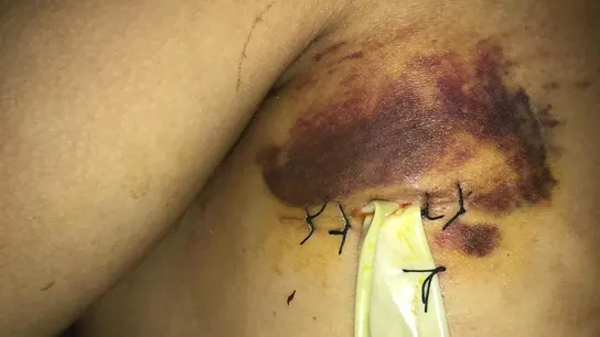 La herida del joven apuñalado en Santa Coloma La herida del joven apuñalado en Santa Coloma