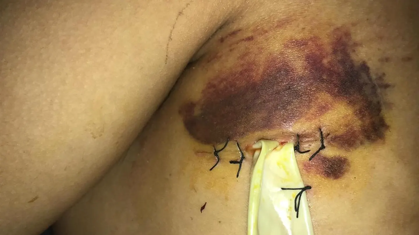 La herida del joven apuñalado en Santa Coloma La herida del joven apuñalado en Santa Coloma