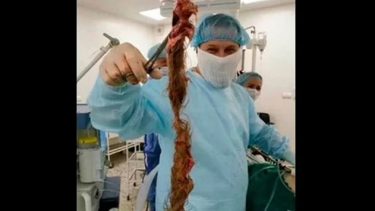 Imagen de la mata de pelo que extrajeron a la joven de los ovarios en Rusia Imagen de la mata de pelo que extrajeron a la joven de los ovarios en Rusia
