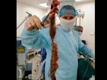 Imagen de la mata de pelo que extrajeron a la joven de los ovarios en Rusia Imagen de la mata de pelo que extrajeron a la joven de los ovarios en Rusia