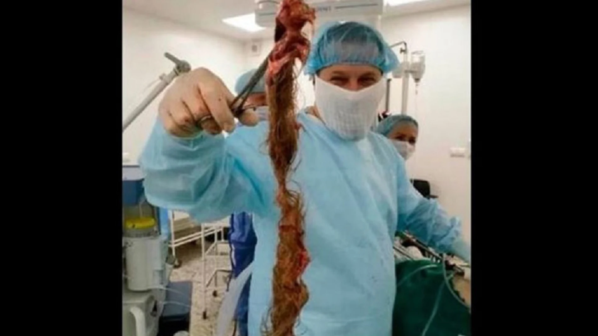 Imagen de la mata de pelo que extrajeron a la joven de los ovarios en Rusia