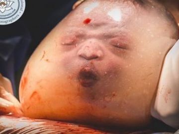 Bebé en una bolsa amniótica Bebé en una bolsa amniótica