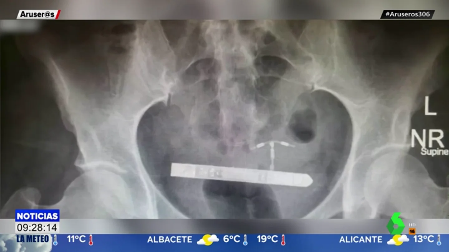 Se le queda un vibrador de nueve centímetros atrapado en el interior de la vejiga y se hace viral Se le queda un vibrador de nueve centímetros atrapado en el interior de la vejiga y se hace viral