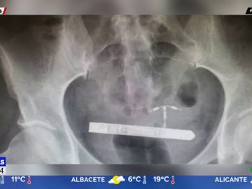 Se le queda un vibrador de nueve centímetros atrapado en el interior de la vejiga y se hace viral Se le queda un vibrador de nueve centímetros atrapado en el interior de la vejiga y se hace viral